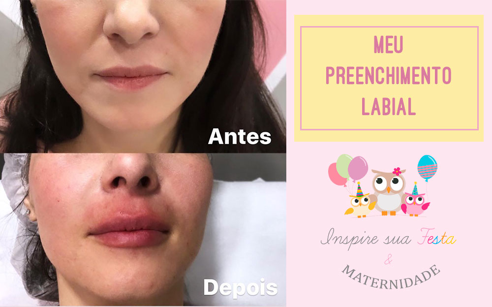 Meu preenchimento labial – Antes, durante e depois